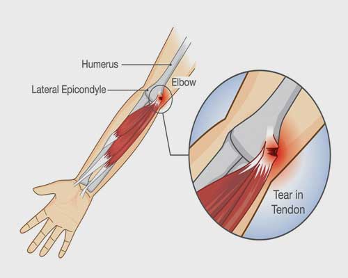 Tennis-Elbow